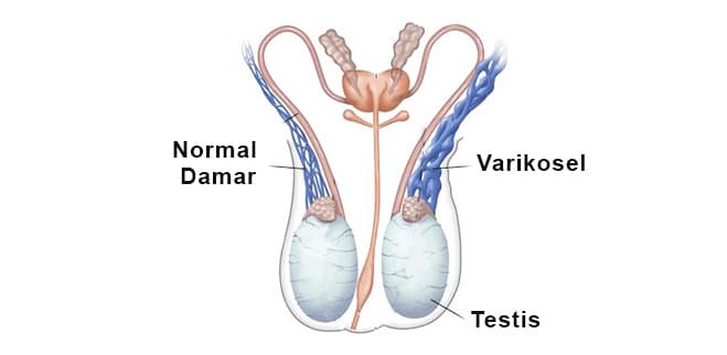 VARKOSEL