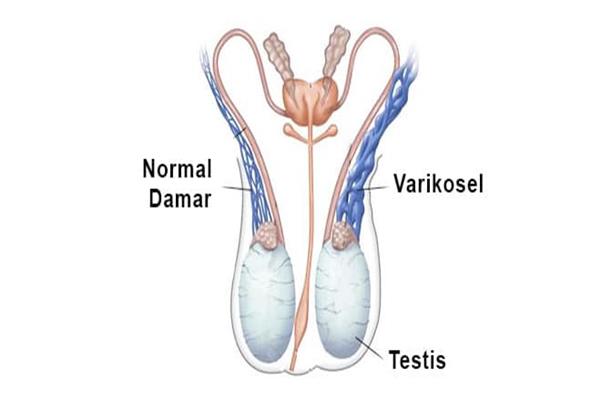 VARKOSEL